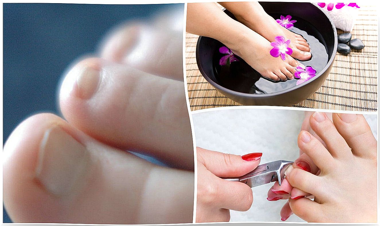 7 things you should know about nail fungus