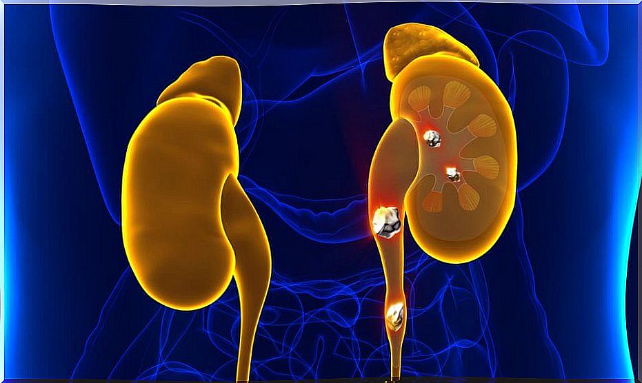 Are there infusions that help dissolve kidney stones?