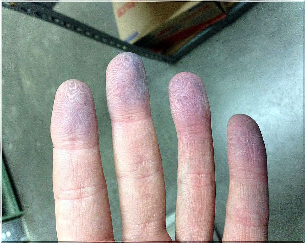 Cyanosed fingers