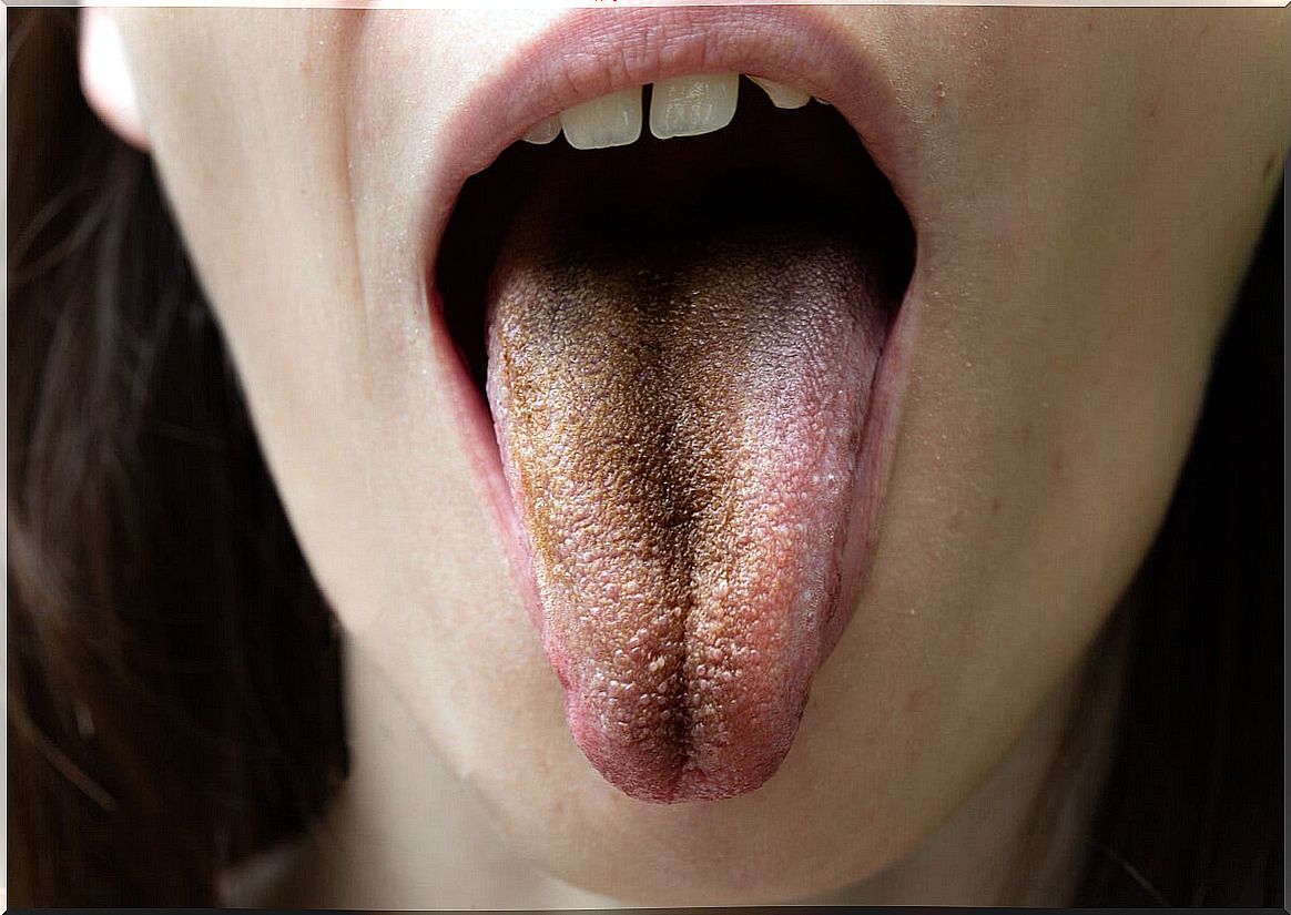 Black Hairy Tongue: Causes, Symptoms and Tips