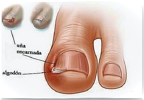 Home treatment for ingrown toenails