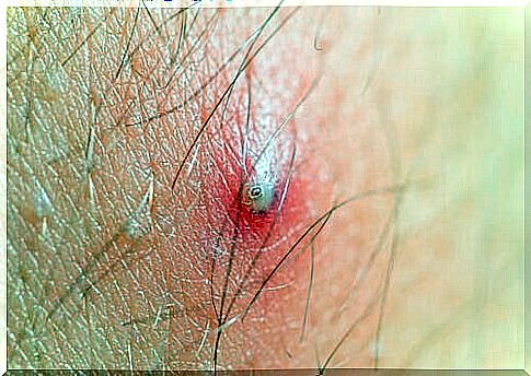 How to avoid and treat ingrown hairs