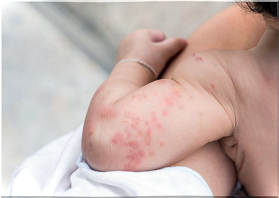 Scarlet fever in babies: what you need to know