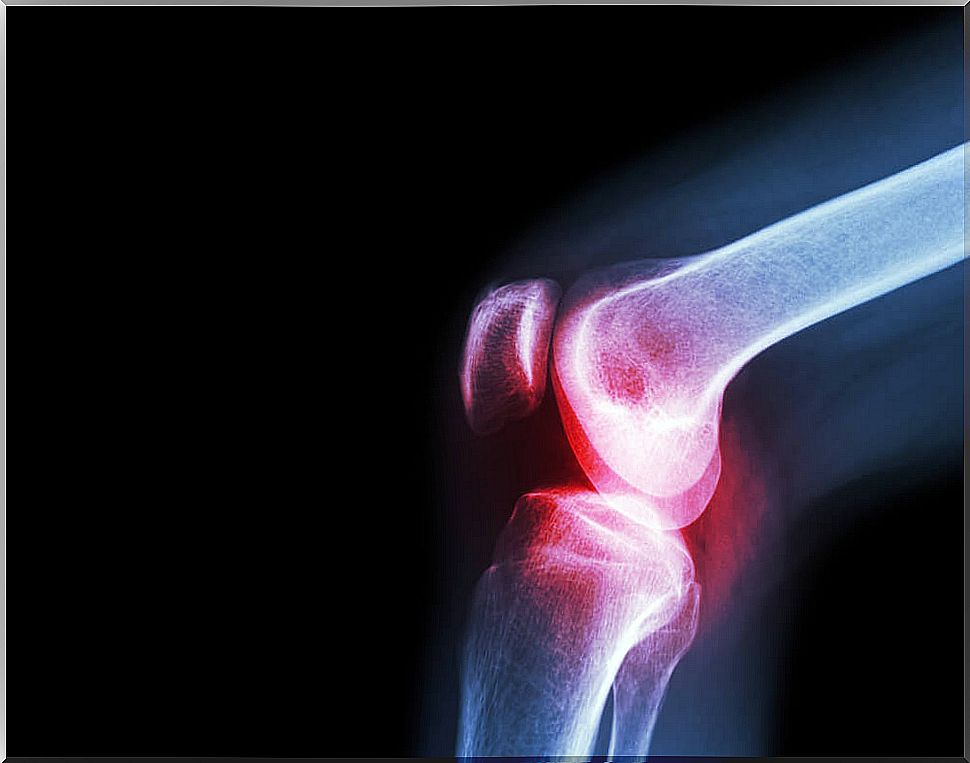Septic arthritis: symptoms and causes