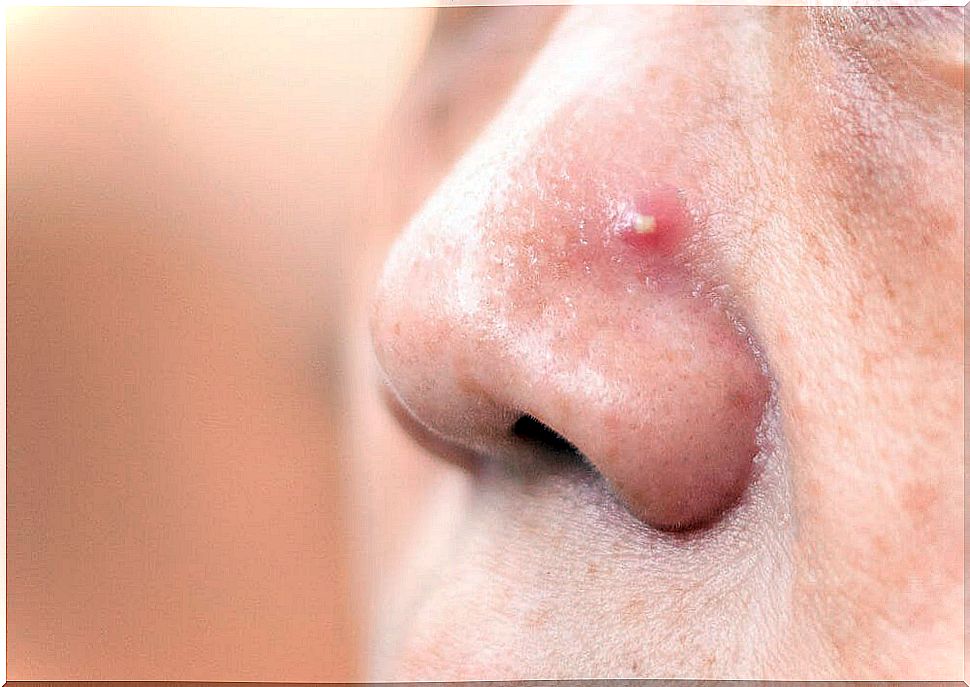 Pimples on the nose to cover with a correct color.